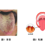 舌苔が誤嚥性肺炎の原因になる！？