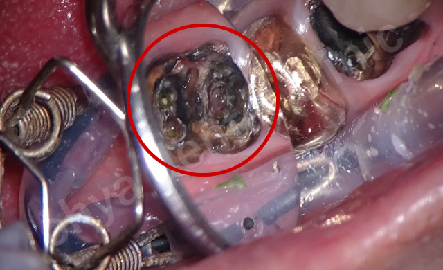 歯の中に大きな穴があり、何度も腫れを繰り返している歯です。