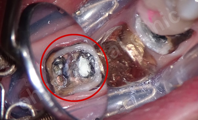このMTAは、象牙質に強固に接着しつつ身体への親和性も抜群に良いです。