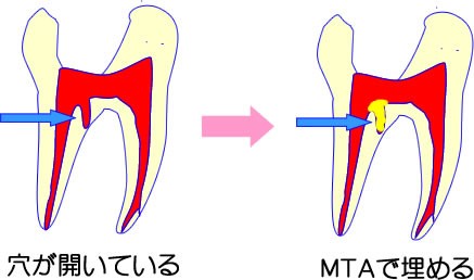 歯に穴が開いている場合のリペア