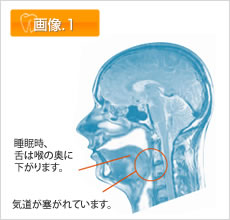 スマイルスリーパーTSDの仕組み 画像1