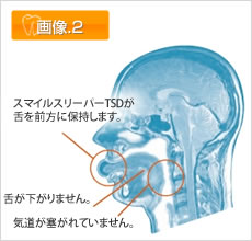 スマイルスリーパーTSDの仕組み 画像2